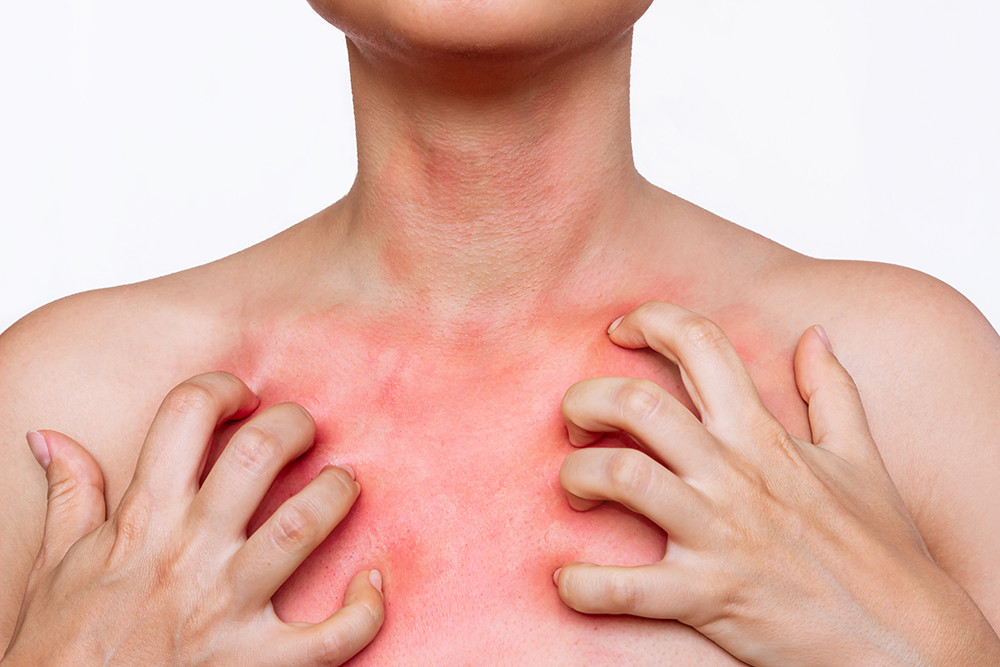 cropped-shot-young-woman-with-red-allergic-rash-her-chest-scratches-skin-with-her-hands.jpg